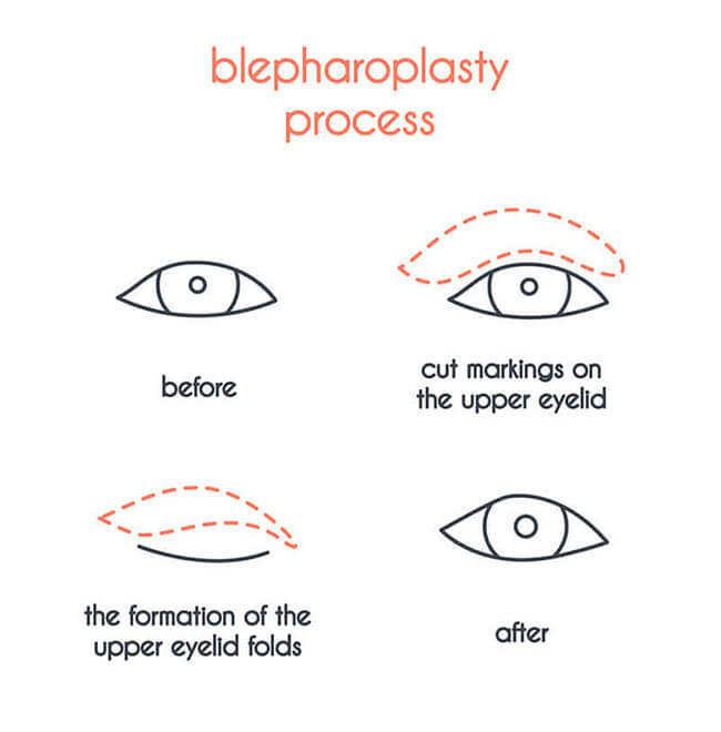 Chart Showing the Blepharoplasty Process